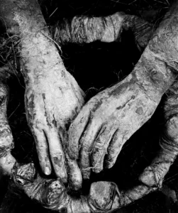 Руки людей с псориазом. Источник: Нью-Йорк Таймс.